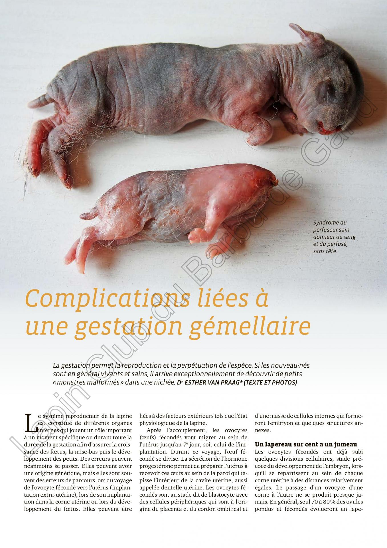 Complications liees a la gestation gemellaire 1